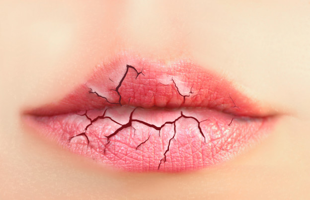 Tipps gegen rissige Lippen im Winter